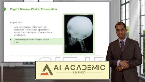 بیماری‌ استخوان