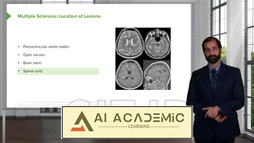 مولتیپل اسکلروزیس