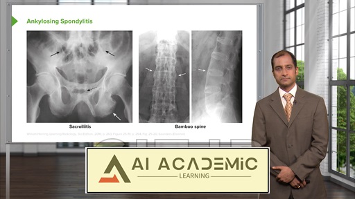 اسپوندیلوآرتروپاتی‌های سرونگاتیو